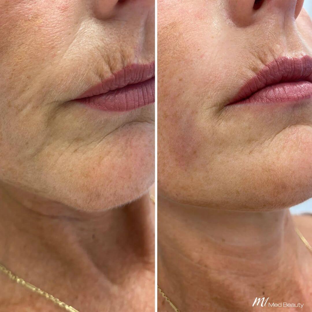 Marionette Lines dermal filler M1 Beauty (5)