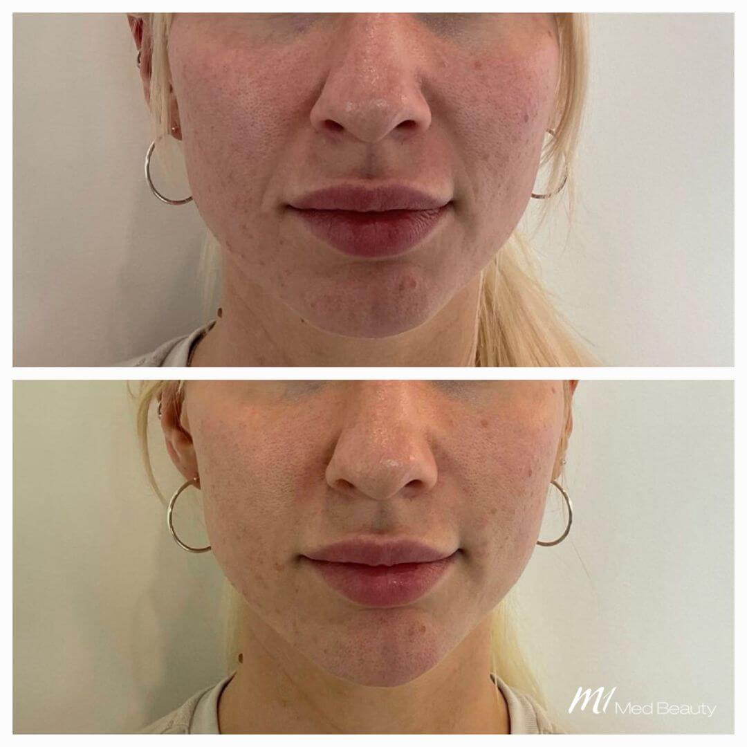 Nasolabial Folds dermal filler M1 Beauty (1)