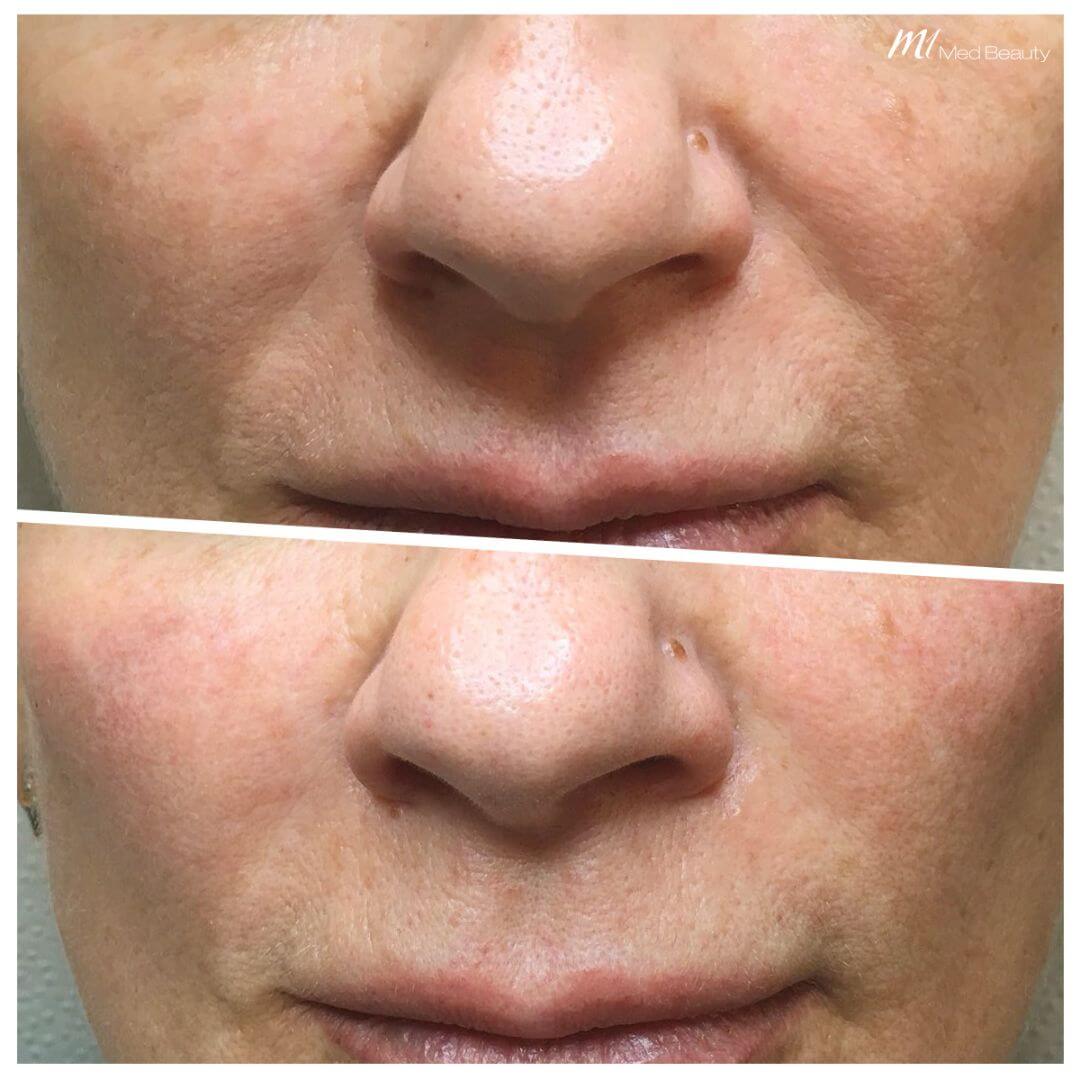 Nasolabial Folds dermal filler M1 Beauty (2)