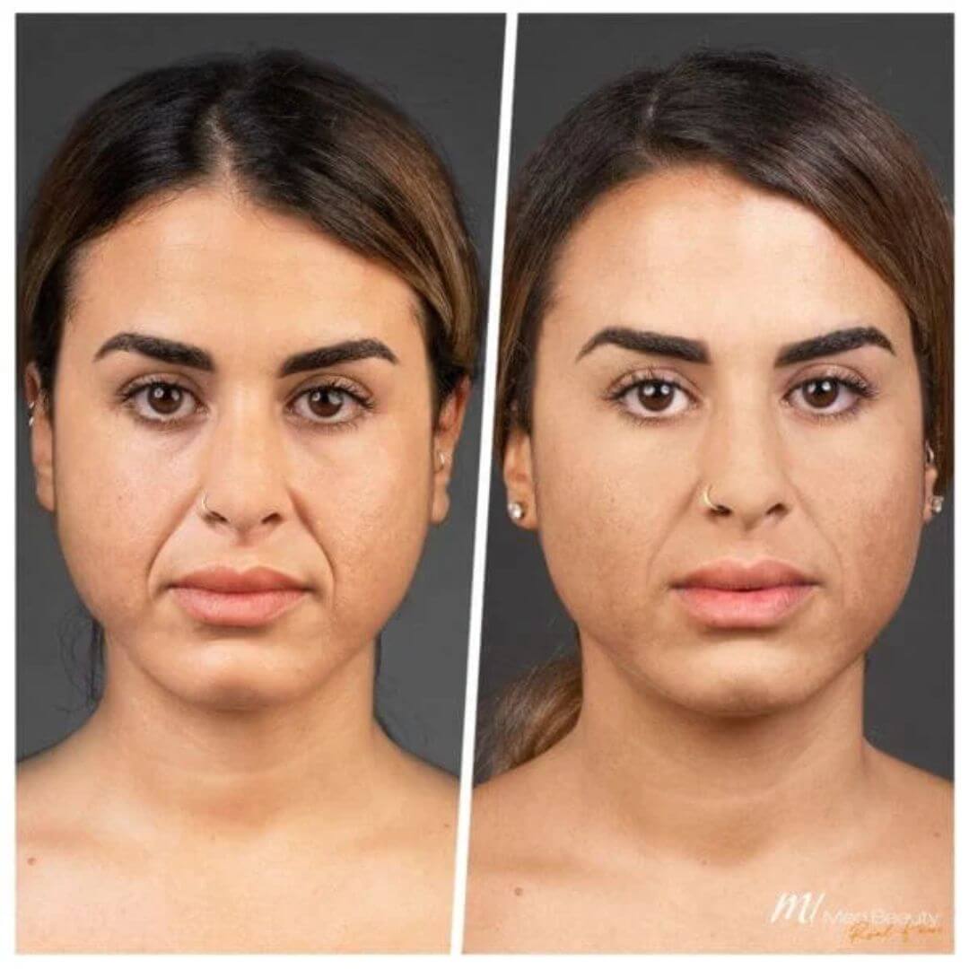 Nasolabial Folds dermal filler M1 Beauty (3)