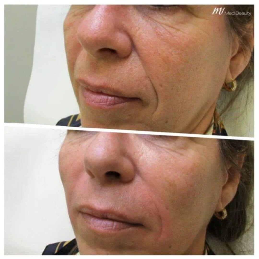 Nasolabial Folds dermal filler M1 Beauty (4)