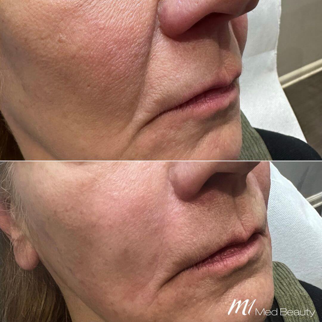 Nasolabial Folds dermal filler M1 Beauty (5)