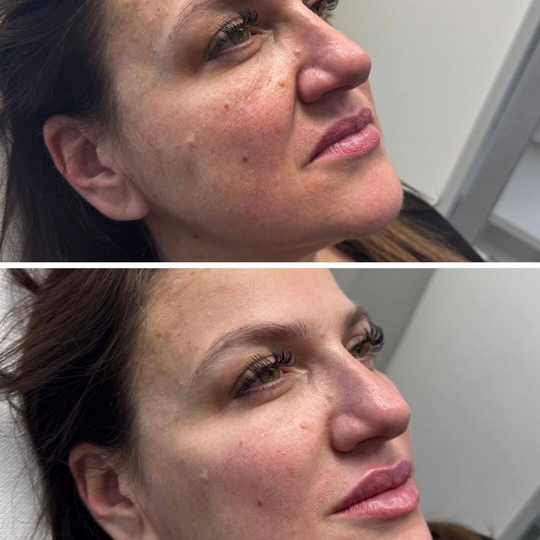Nasolabial Folds dermal filler M1 Beauty (6)