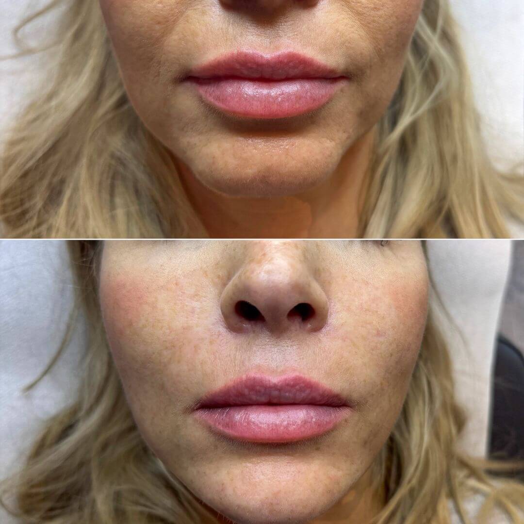 Nasolabial Folds dermal filler M1 Beauty (7)