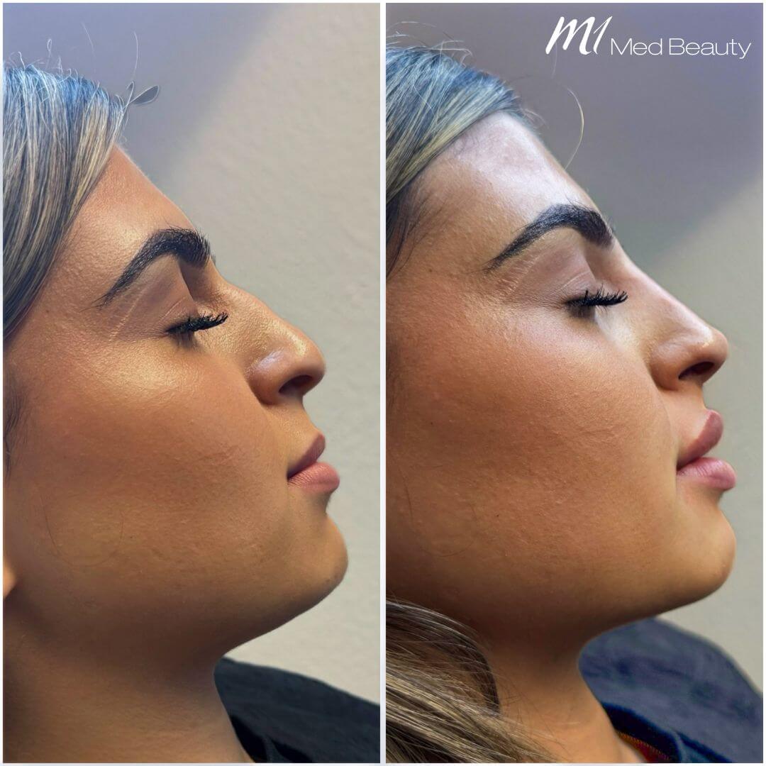 Nose Tip