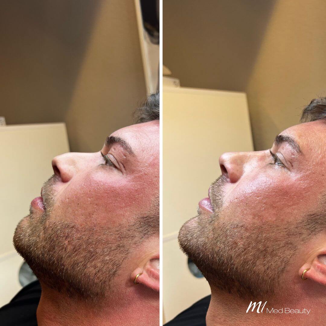 Nose Tip (3)
