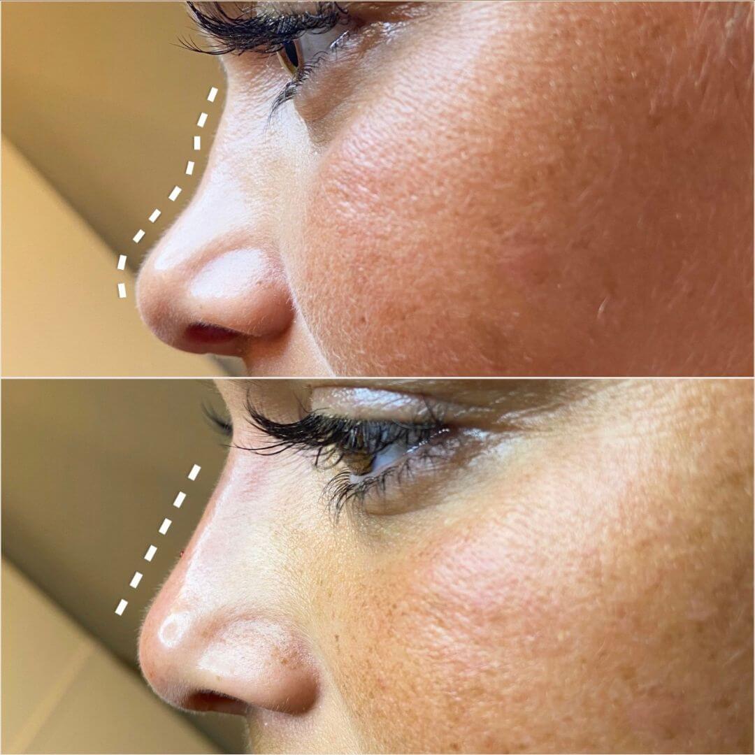 Nose dermal filler M1 Beauty (2)