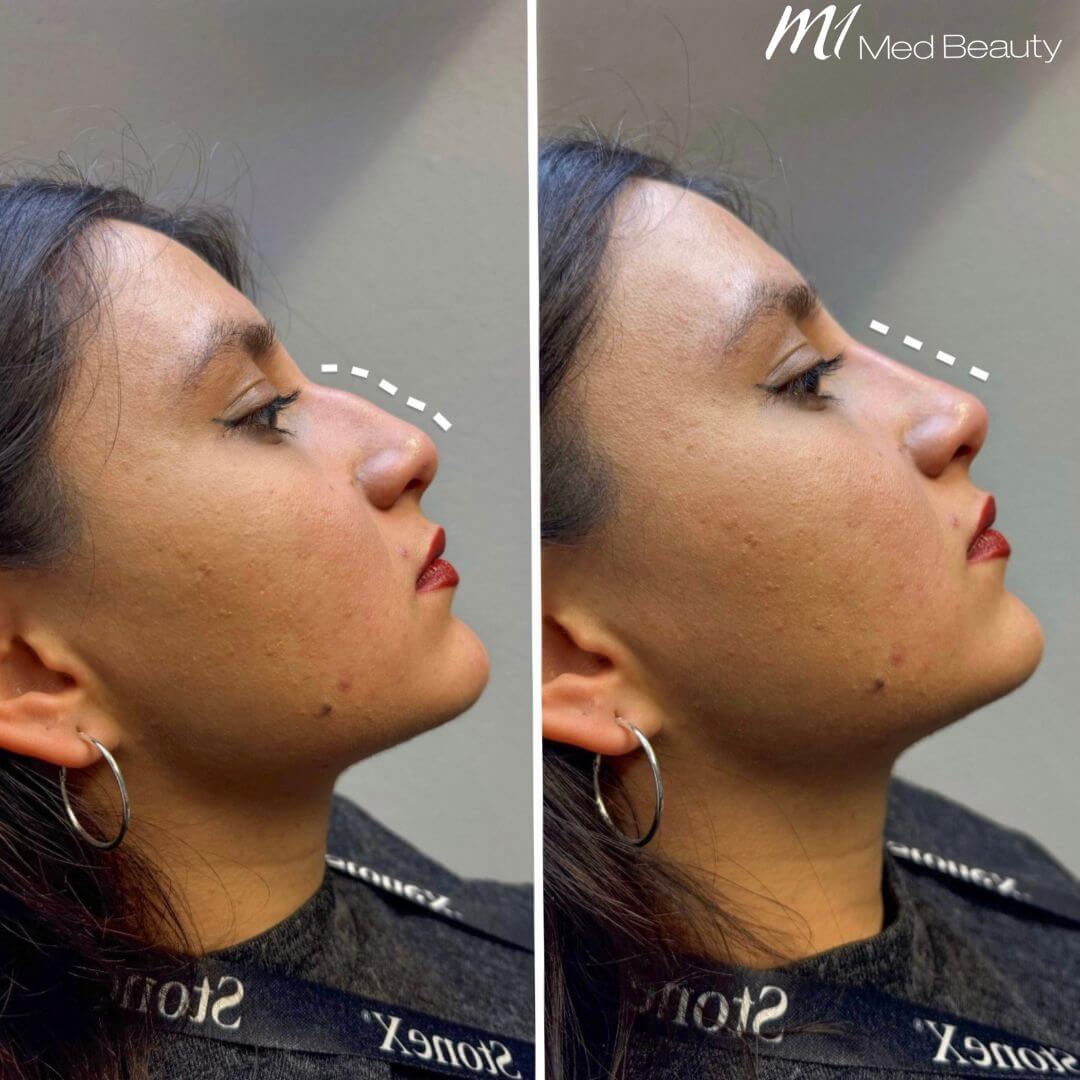 Nose dermal filler M1 Beauty (6)