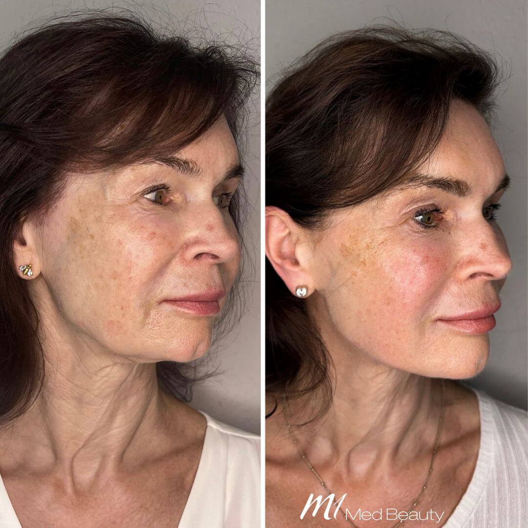 Skin booster M1 Beauty (2)