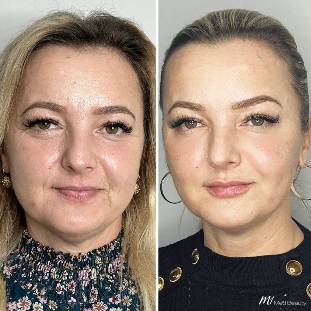 Tear Through dermal filler M1 Beauty (1)