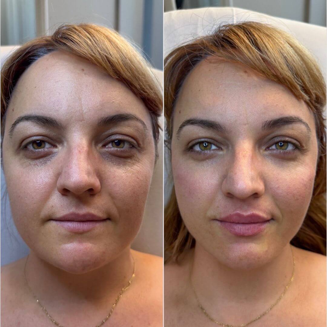 Tear Through dermal filler M1 Beauty (2)