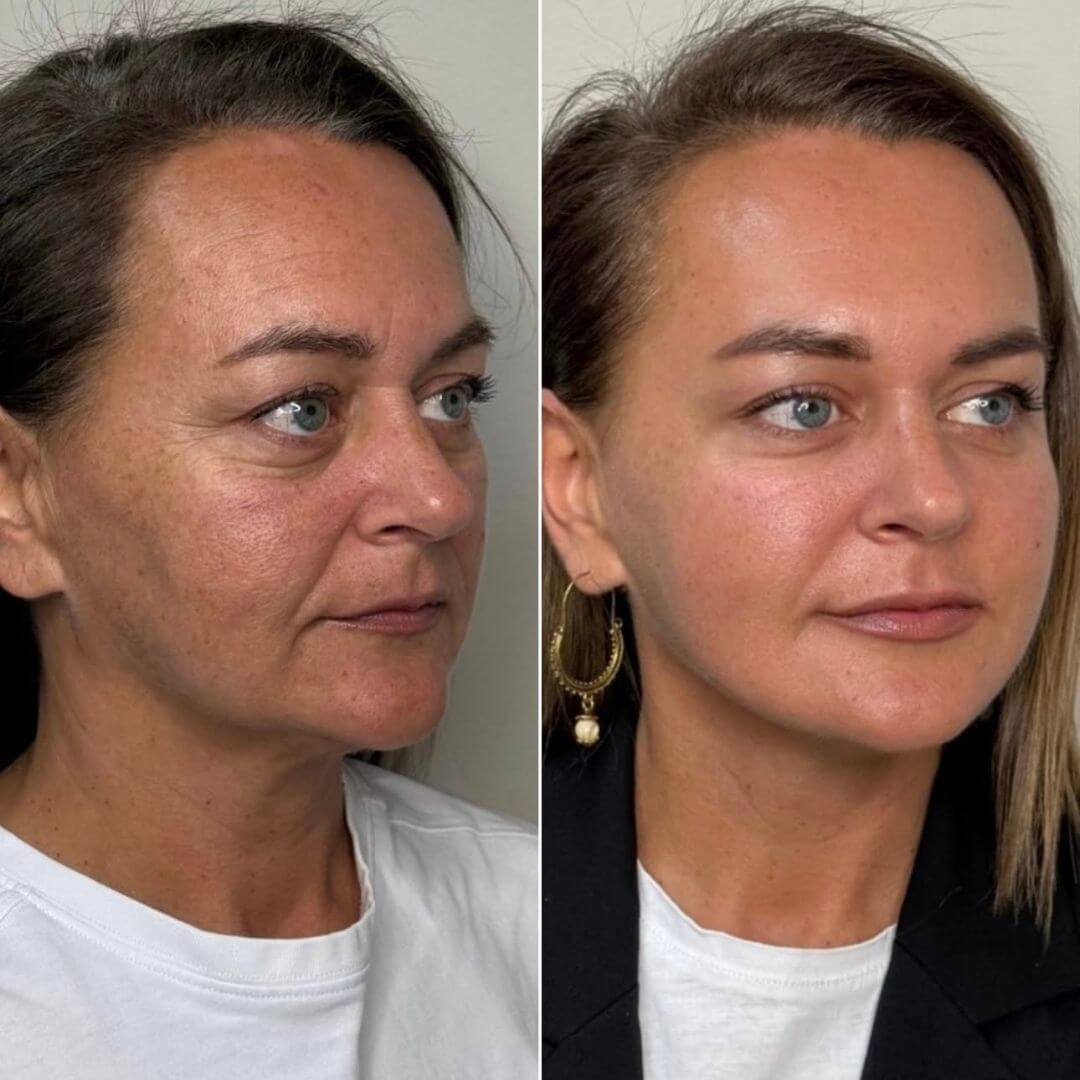 Tear Through dermal filler M1 Beauty (3)