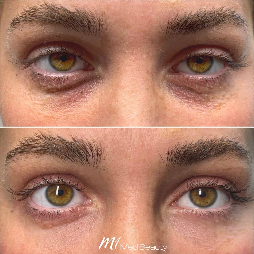 Tear Through dermal filler M1 Beauty (5)