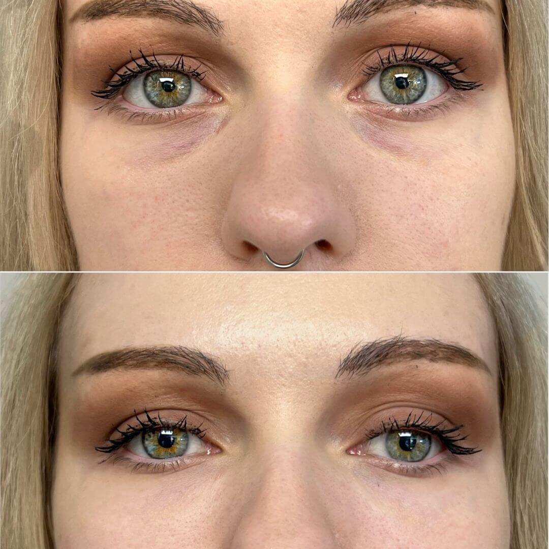 Tear Through dermal filler M1 Beauty (6)
