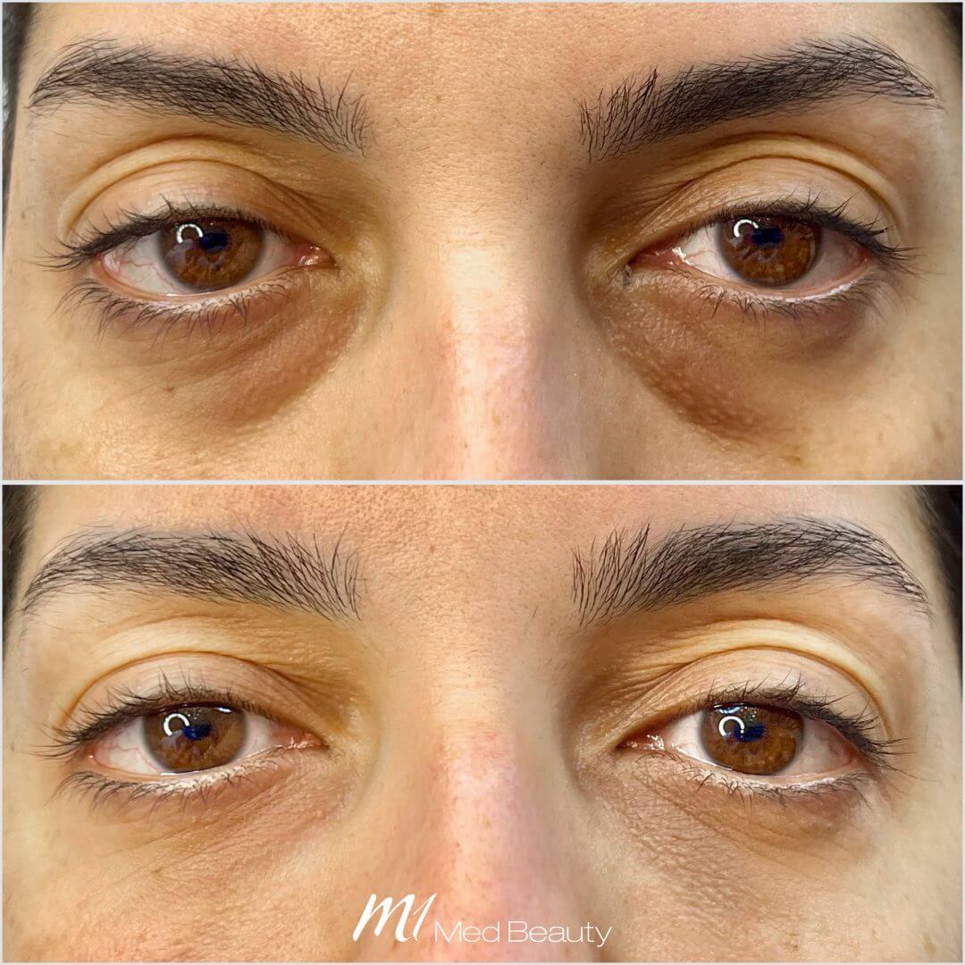 Tear Through dermal filler M1 Beauty (7)