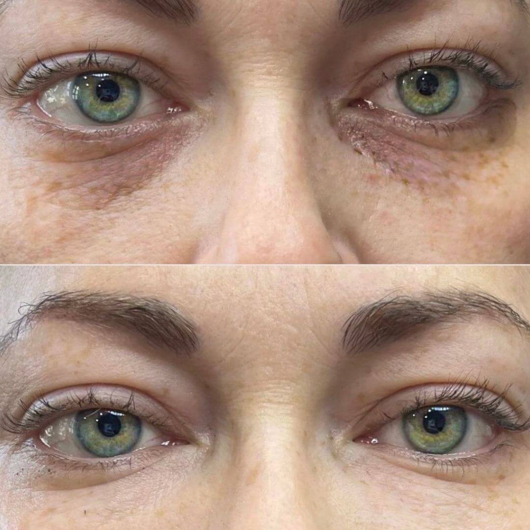 Tear Through dermal filler M1 Beauty (8)