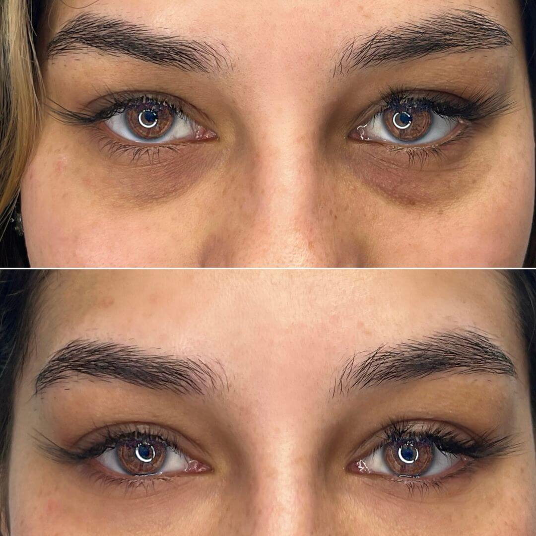 Tear Through dermal filler M1 Beauty (9)
