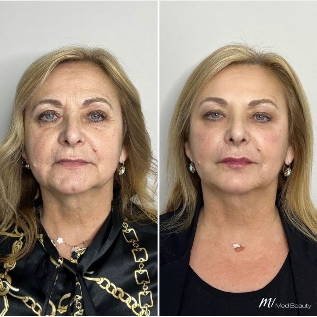 Upper Lip Folds dermal filler M1 Beauty